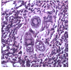 <p>Figure E: __________in a urinary bladder biopsy specimen, stained with H&amp;E. Images courtesy of the Michael E. DeBakey V. A. Medical Center, Houston, TX.</p>