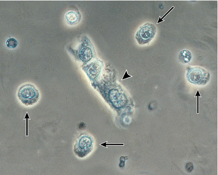<p>-Collection of Renal tubular epithelial cells</p><p>-Associated with ATN</p>