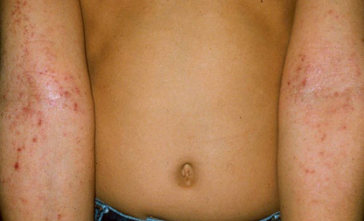 <p>what type of lesion is depicted and when does it occur</p>