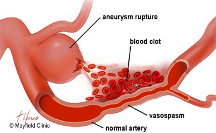 <p>the initial step in hemostasis, in which the smooth muscle in the walls of the ruptured or damaged blood vessels contracts</p>