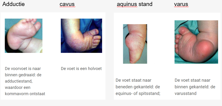 <ol><li><p>Adductie van de voet (voorvoet naar binnen gedraaid).</p></li><li><p>Cavus (holle stand).</p></li><li><p>Equinus stand (voet in spits).</p></li><li><p>Varus (achtervoet naar binnen gedraaid)</p></li></ol><p></p>