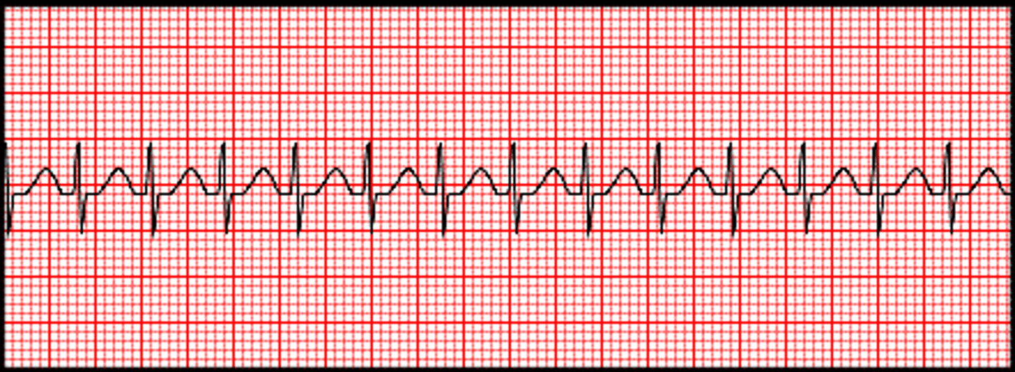 <p>Which Arrythmia is this?</p>