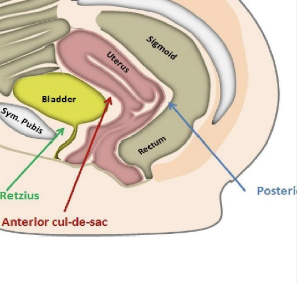 <ul><li><p><span style="color: yellow;"><strong>anterior cul-de-sac</strong></span> (<span style="color: yellow;">vesicouterine</span> pouch)</p><ul><li><p>in front of uterus</p></li></ul></li><li><p><span style="color: yellow;"><strong>posterior cul-de-sac</strong></span> (<span style="color: yellow;">pouch of Douglas</span>/<span style="color: yellow;">rectouterine</span> space)</p><ul><li><p>behind uterus</p></li><li><p><strong>FF often accumulates here</strong> b/c of gravity and bigger space</p></li></ul></li><li><p><span style="color: yellow;"><strong>Space of Retzius</strong></span> (<span style="color: yellow;">retropubic space</span>)</p><ul><li><p>in front of bladder</p></li><li><p>“between anterior bladder and pubic symphysis”</p></li></ul></li></ul><p></p>