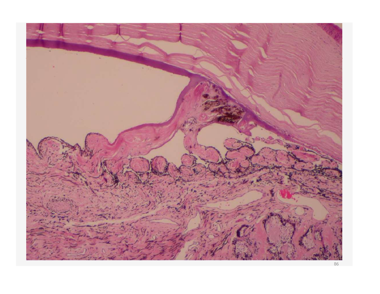 <p>is this primary or secondary glaucoma?</p>
