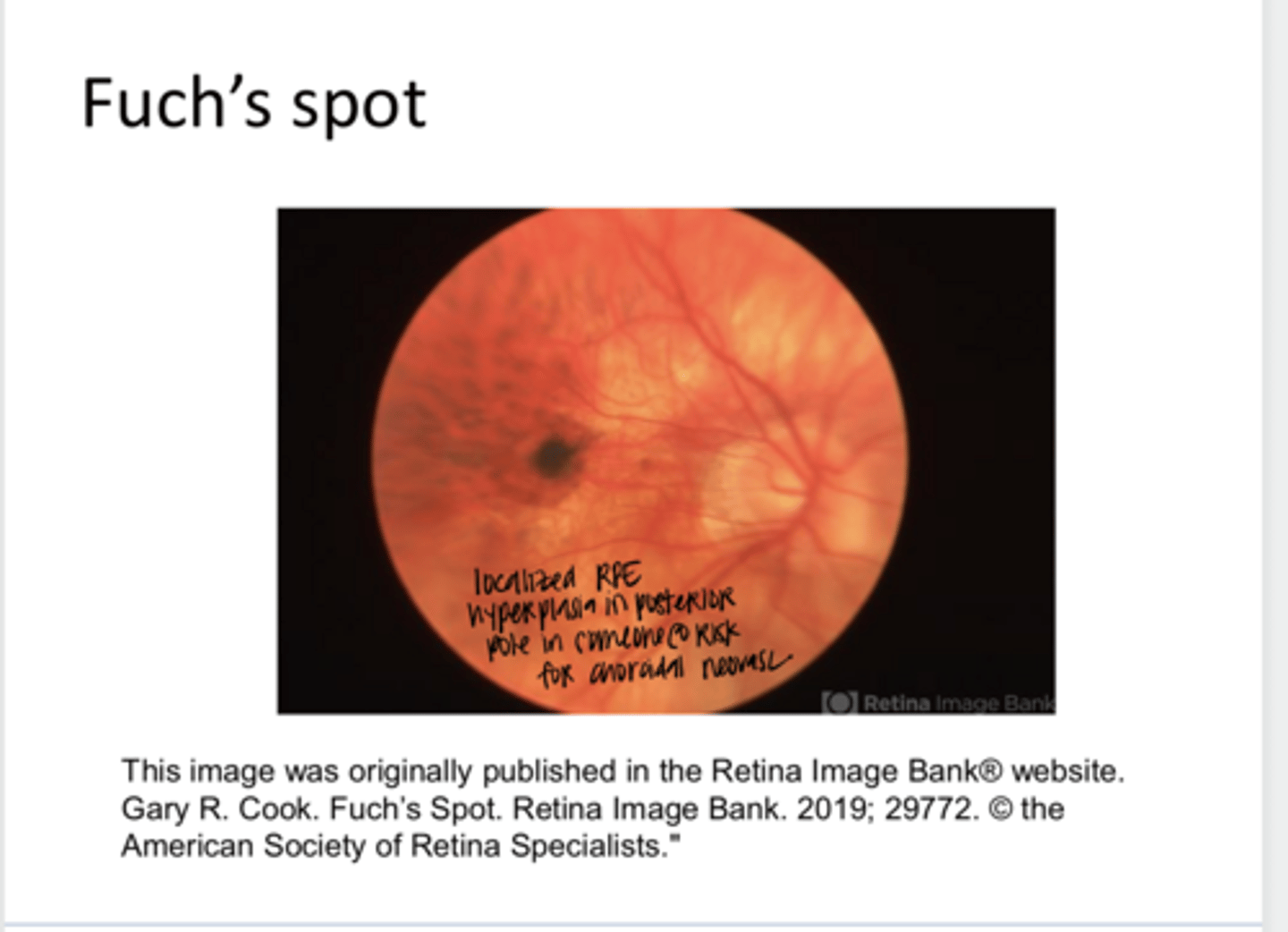<p>Fuch's Spot -- Localized RPE Hyperplasia in Posterior Pole in Someone Who is At Risk for Choroidal Neovasc (Pic)</p>