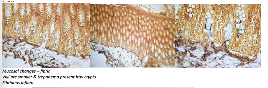 <p>Colitis fibrinosa (Levaditi)</p>