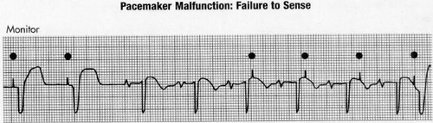 <p>Spikes happen regardless of QRS on their own</p>