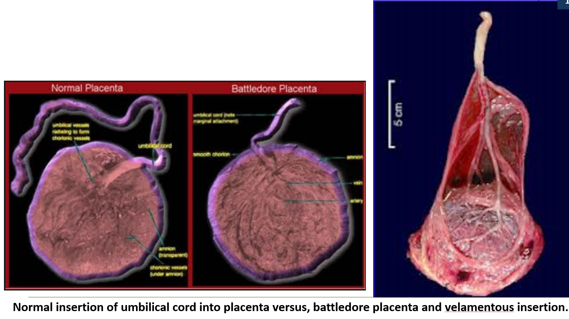 <ul><li><p><strong>Battledore placenta</strong>: insertion at the <strong>edge</strong> of the placenta</p></li><li><p><strong>Velamentous insertion</strong>: insertion into <strong>fetal membranes</strong>, with vessels exposed between <strong>amnion and chorion</strong>, making them <strong>easily torn</strong>.</p></li></ul><p></p>