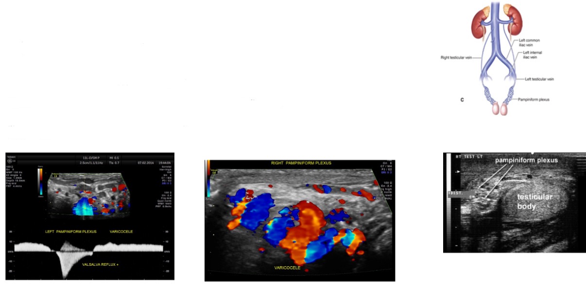 <p><strong>Venous drainage </strong>of the scrotum occurs through _________. Pampiniform plexus exits from mediastinum testis and courses in spermatic cord.</p>