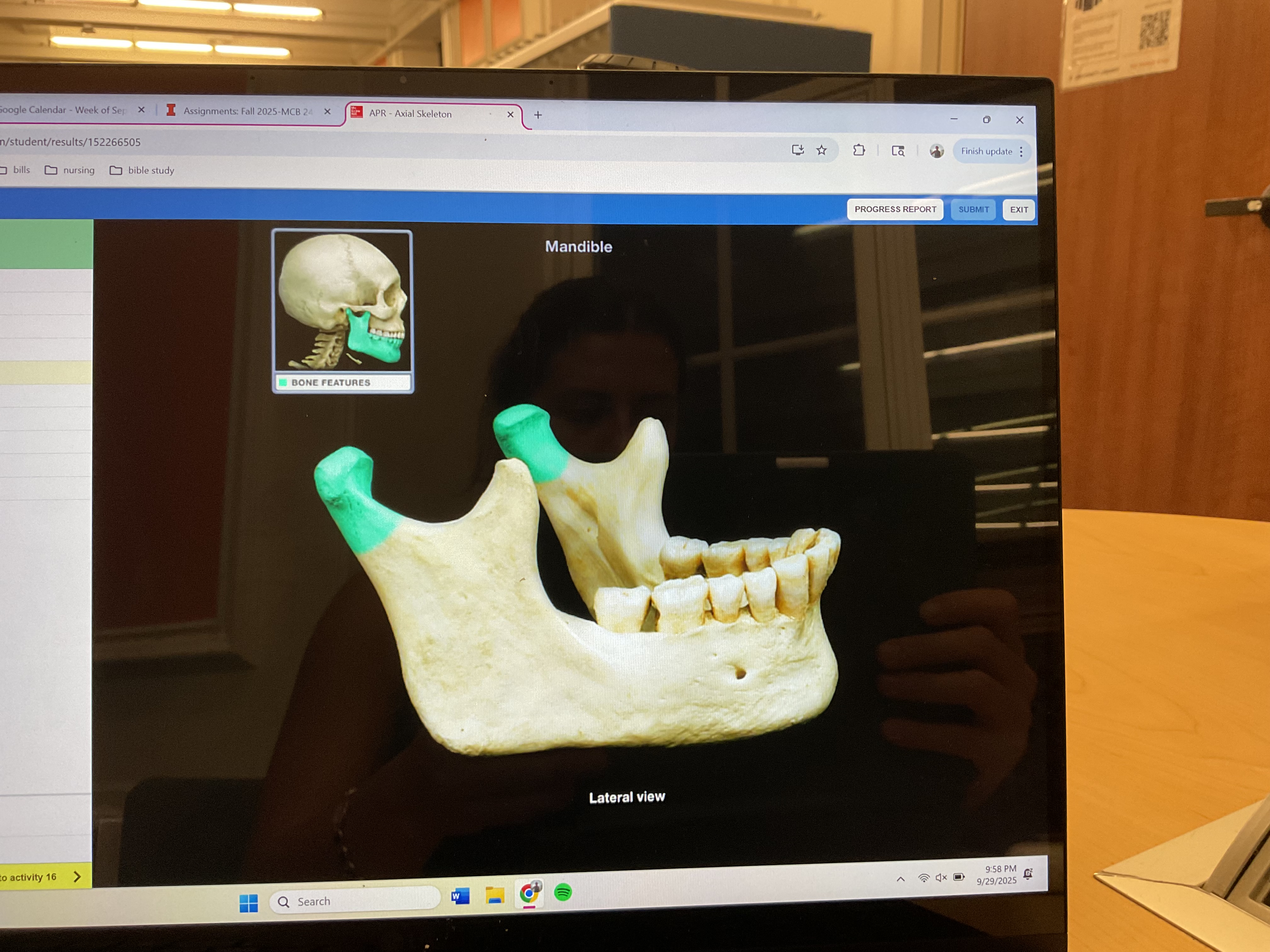 <p>Condylar process of mandible</p>