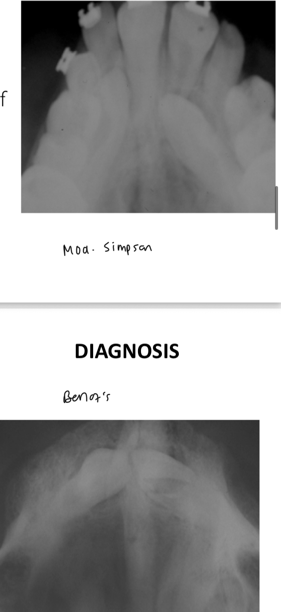 <p>Modified Simpson- beam perpendicular to sensor and parallel to incisors axis </p><p>Belot’s method- not perpendicular, palatal canines appear palatal but Buccal can be either </p>