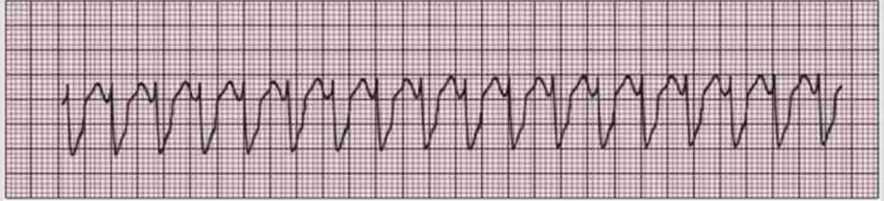 <p>EKG</p>