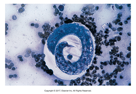 <ul><li><p>Unique in that L1 phase is infective</p></li><li><p>No outside development is necessary​</p></li><li><p>Dogs are definitive host​</p></li><li><p>Cause of infection: Ingestion of larvae 232-266 um, often from mom to puppies via the mouth​</p></li><li><p>Adults found at the bifurcation of trachea in nodules​</p></li><li><p>Prepatent period: 10 weeks</p></li></ul><p></p>