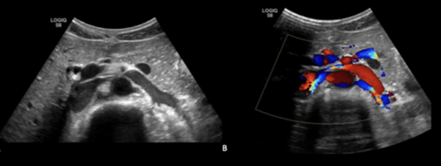 <p>Left renal vein compressed by SMA</p>