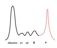 Spike in gamma (M spike); multiple myeloma