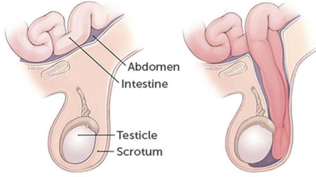 <p>refers to the defect in the abdominal wall which allows portions of intestine to pass through the inguinal canal and enter scrotal sac</p>