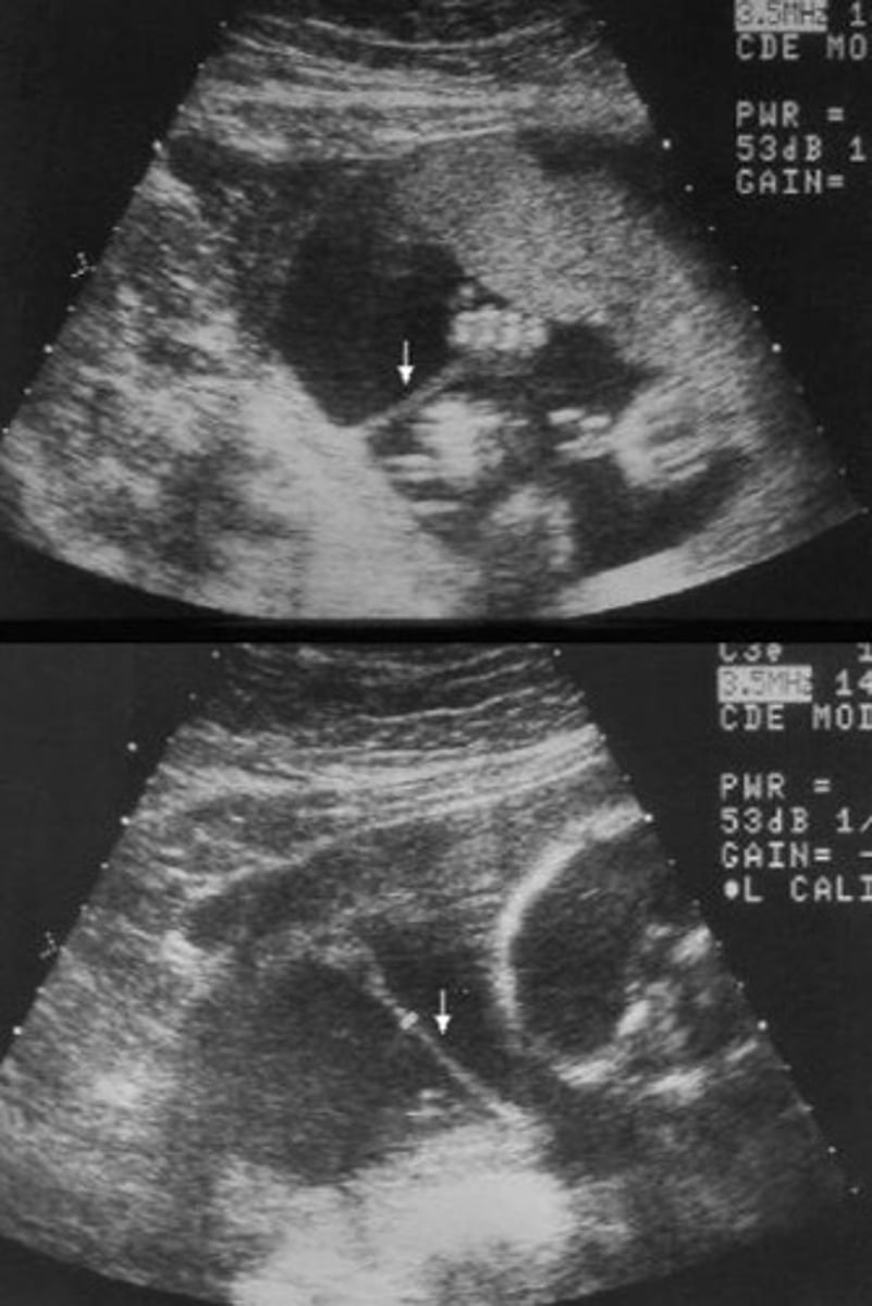 <p>Amniotic band syndrome</p>