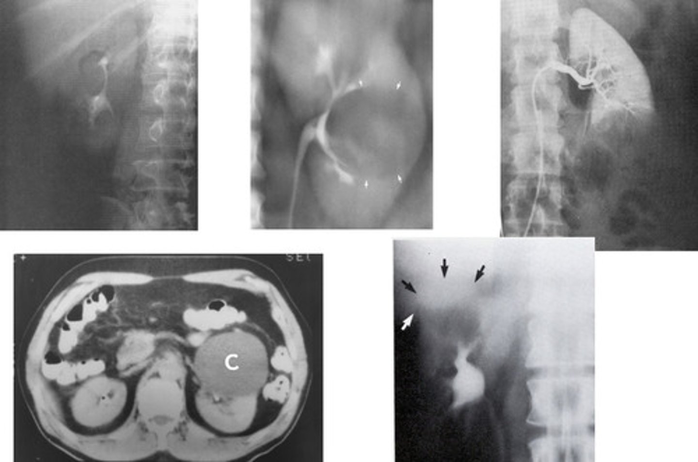 <p>- What are fluid filled sacs that forms on/in the kindey, displaces the calyces as it grows, may be single/multiple, and vary in size?</p><p>- What imaging modalities are used to diagnose this pathology?</p>