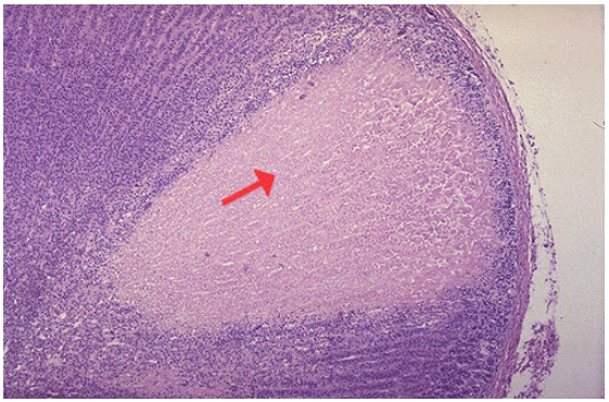 <ol><li><p>Identify the type of cell death and CD</p></li><li><p>Why is t<span>he area just under the capsule is spared?</span></p></li></ol><p></p>