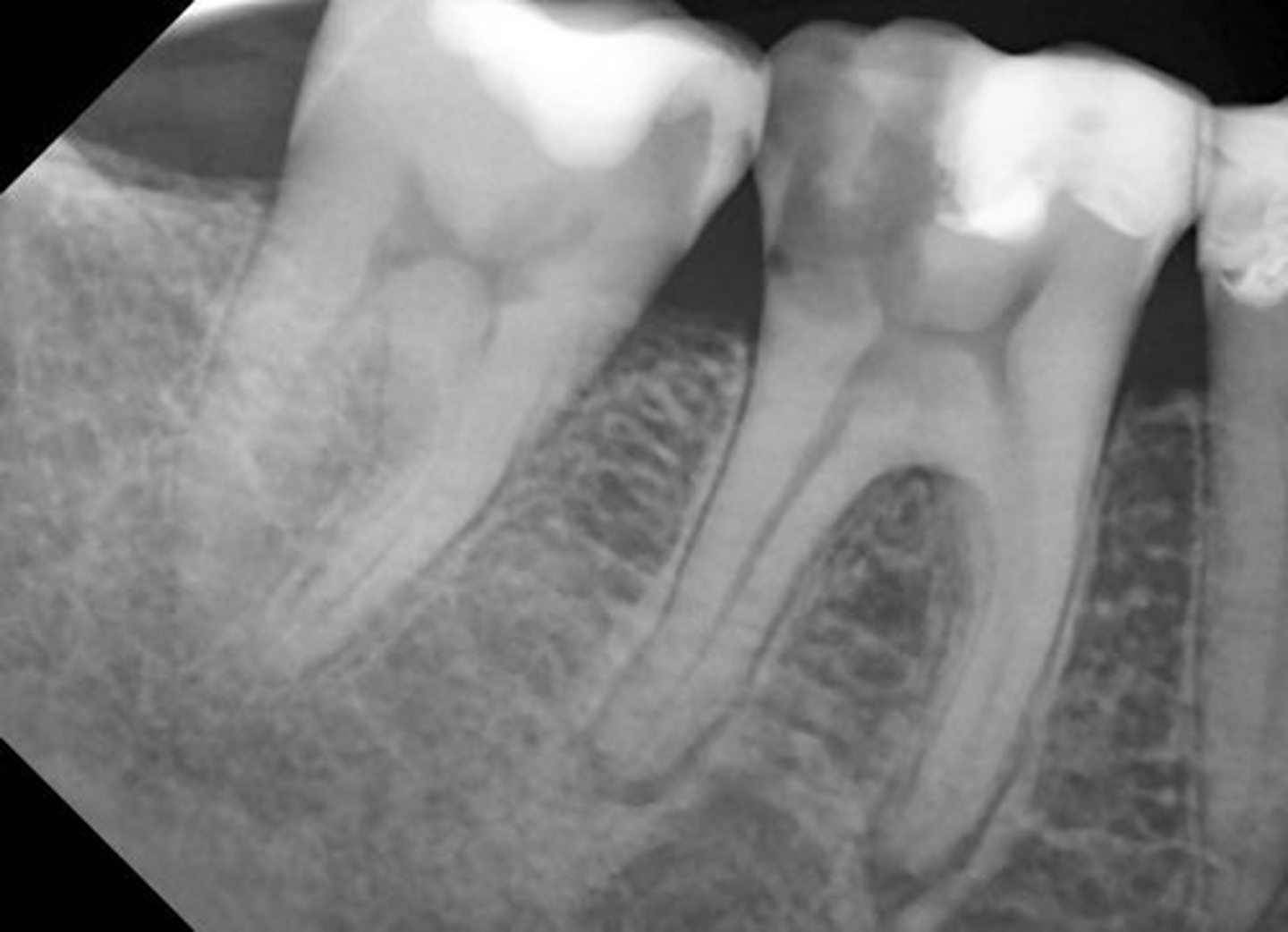 <p>widened PDL space</p><p>Thickening of the lamina dura</p>