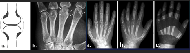 <ul><li><p>Focal soft tissue swelling</p><ul><li><p> early=> MCPh, PIPh, ulnar styloid</p></li></ul></li><li><p>OP</p><ul><li><p>early=> juxtaarticular, band</p></li><li><p>late=> diffuse</p></li></ul></li><li><p>Erosions</p><ul><li><p>early=> decreased cortical differentiation (dot dash pattern)</p></li><li><p>marginal = moue ears at basis of the phalanges</p></li><li><p>subchondral=> pen in cup, destruction of ulna, carpal bones</p></li></ul></li><li><p>Cartilage destruction</p><ul><li><p>early false increased of joint space (effusion)</p></li><li><p>destruction & narrowing of joint space</p></li></ul></li><li><p>Subchondral cysts</p></li><li><p>Malalignement</p><ul><li><p>carpal: ulnar deviation and scaphoid luxation</p></li><li><p>fingers: MCPh, ulnar deviation, subluxation</p></li></ul></li></ul><p></p>