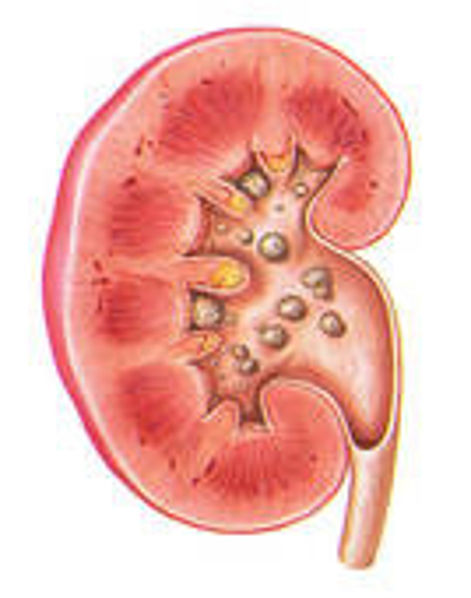 <p>Stone</p><p>Ex: nephrolithiasis</p>