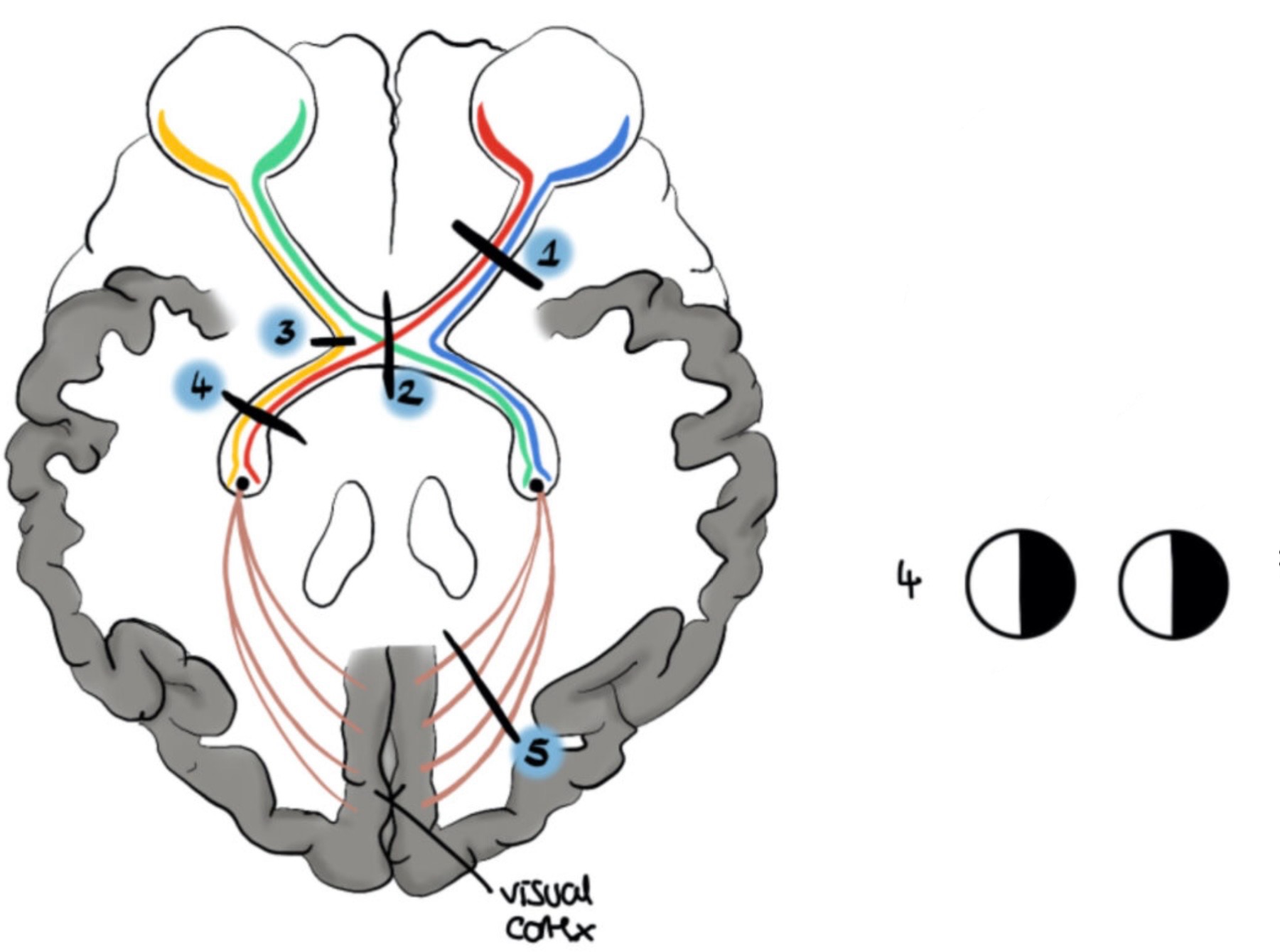<p>What visual field defect is shown</p>