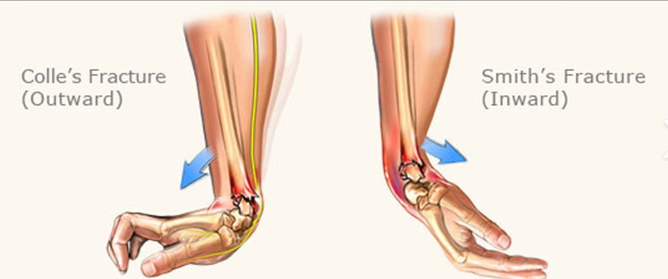 <p><strong><u>2 Types: </u></strong>Dorsal angulation of distal radius (<strong>Colle’s</strong>) and Volar angulation of distal radius (<strong>Smith’s</strong>)</p><p><u>Clinical Presentation:</u> Pain, swelling, <strong>visible deformity</strong></p><p><u>Diagnosis:</u> Traumatic MOI, limited ROM, X-ray</p><p><u>Risk factors:</u> low level trauma, ~61 years, <strong>FOOSH</strong></p><p><u>Management</u>: <strong>casting</strong>, conservative (depending on degree of displacement), surgical stabilization, Physio → ROM, strength, control</p>