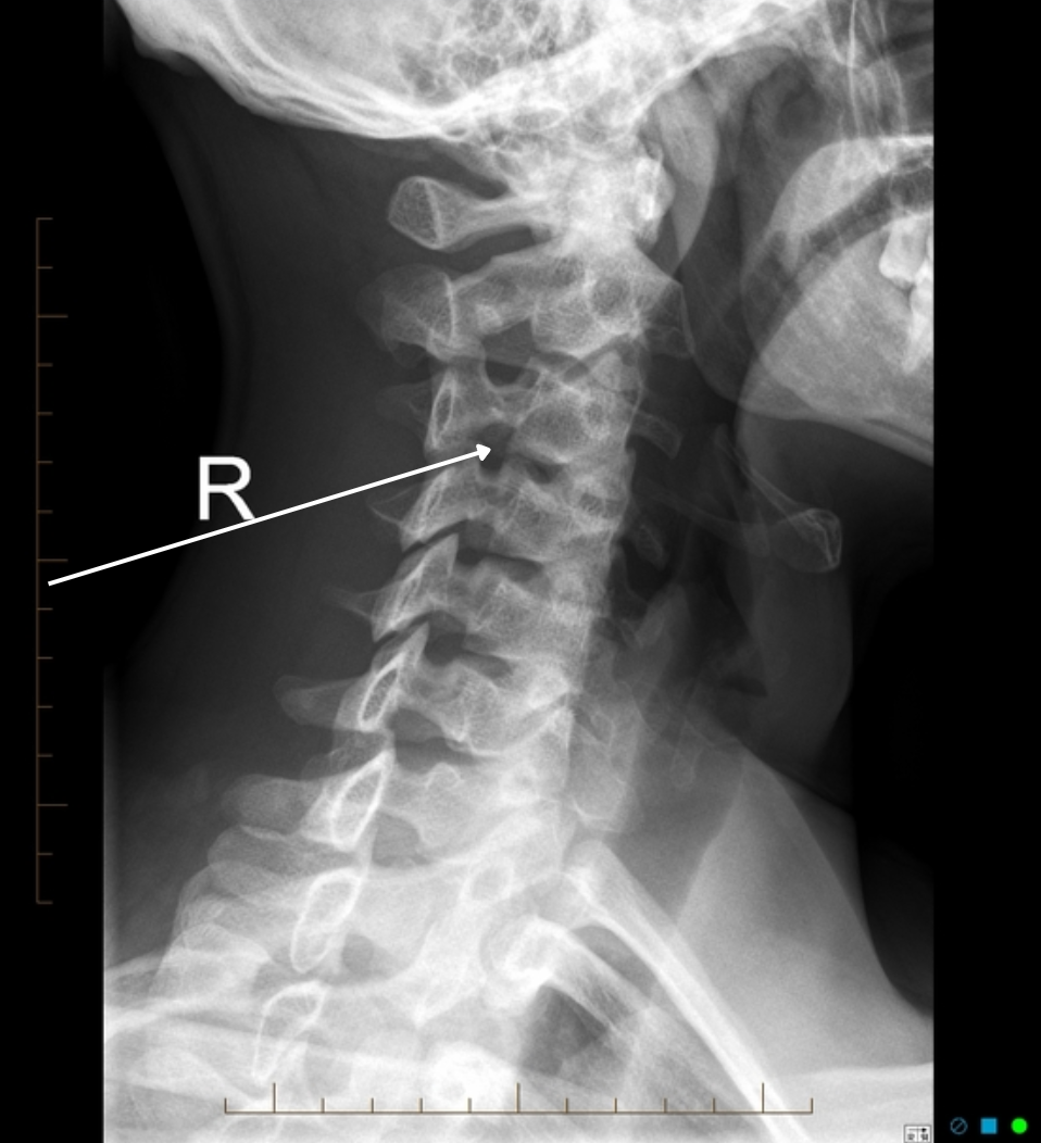 <p>right PA oblique</p>