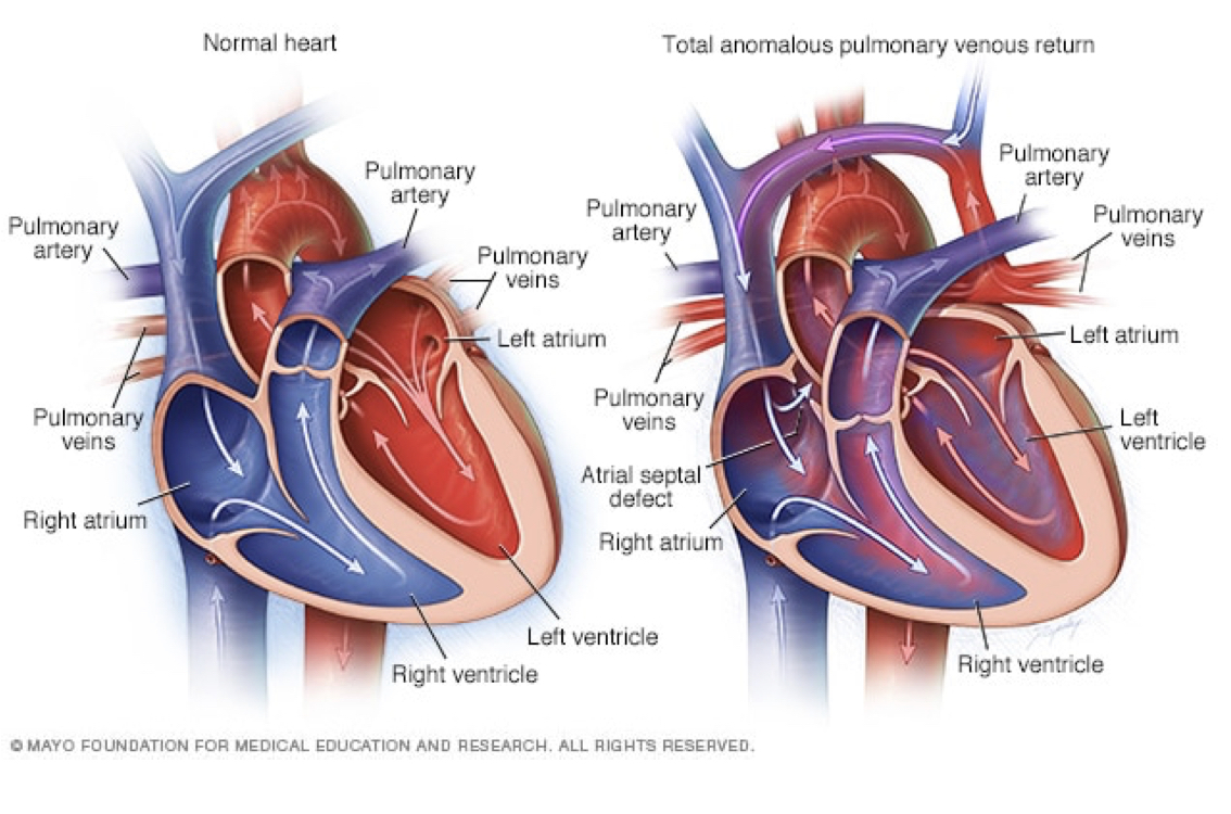 <ul><li><p>pulmonary veins have no connection to the left side of the heart</p></li><li><p>blood flow pathway</p></li><li><p>results in over circulation of right side of heart and lungs and inadequate blood flow to the body</p></li></ul><p></p>