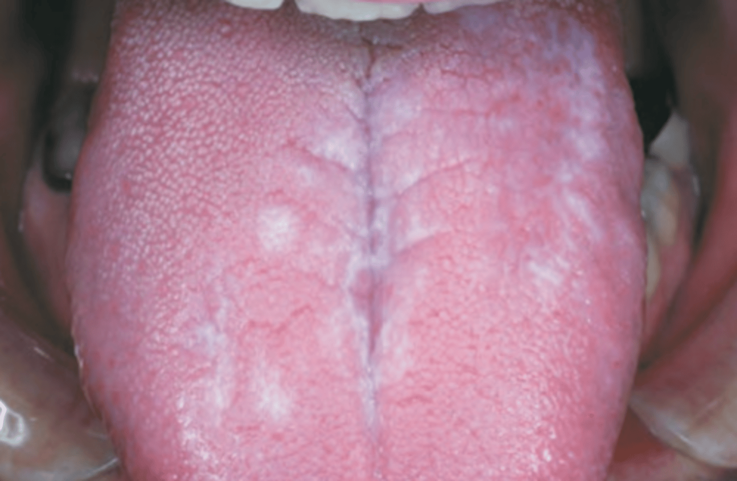 <p>Hint: Lesions wax and wane</p>