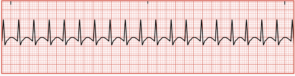 <p>originates in AV node and can cause excessive excitability of the atrial tissue resulting in an increased HR</p><ul><li><p>occurs abruptly and suddenly ends without warning&nbsp;</p></li></ul><p></p>
