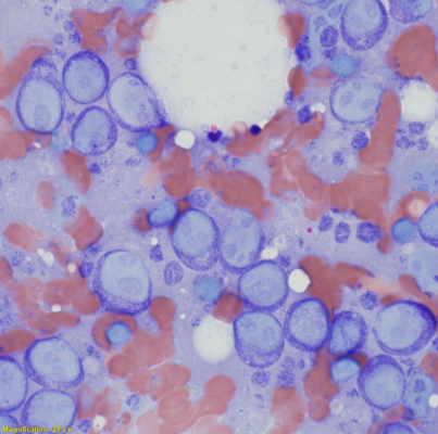 <p>Lymph node cytology</p><p>Enlarged lymph nodes - disease</p><p>What is this?</p>