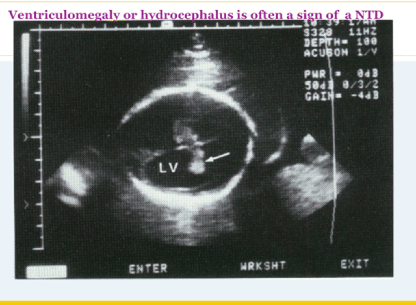 <p>Dilation of the cerebral ventricles without enlargement of the cranium. Occurs because of obstruction of outflow of CSF from the ventricles. Often sporadic and benign. Non-specific, but can indicate Dandy-Walker malformation, possible aneuploidy, variable future cognitive deficits</p>