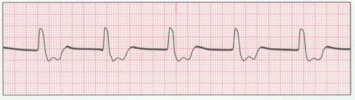 <p>-absence of P waves </p><p>-wide QRS</p><p>-rate &lt;40bpm (ventricular origin)</p><p>-regular</p>