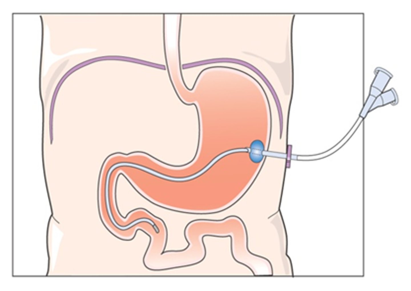 <p>can be placed surgically or endoscopically, long term nutrition</p>