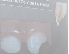 <p><span>fractura que afecta al esmalte exclusivamente, o que afecta tanto al esmalte como a la dentina pero sin exponer la pulpa</span></p>