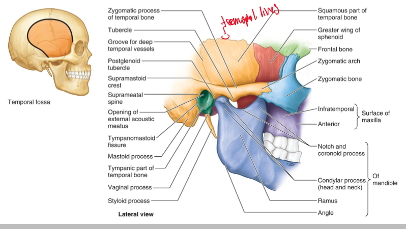 <p>Superiorly by the <strong>temporal lines</strong>, and inferiorly by the <strong>zygomatic arch</strong>.</p>