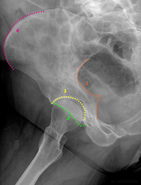 <p>What view do you need to see a acetabulum fracture?</p>