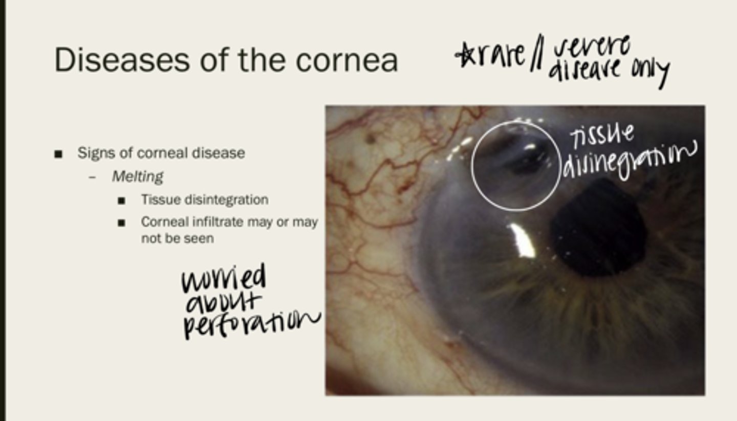 <p>Will a corneal infiltrate be seen with corneal melting?</p>