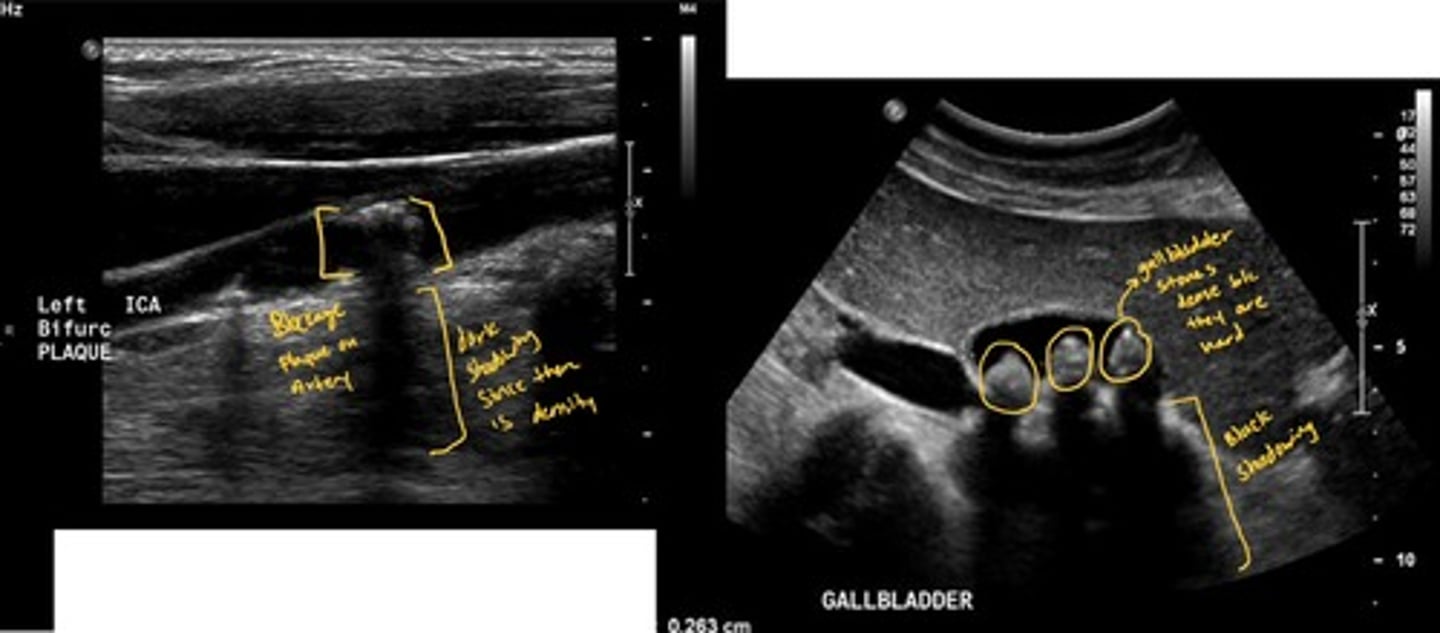<p>When a very dense structure, such as a gallstone or bone, reflects so many echoes that virtually no sound waves are transmitted, the tissue deeper to this structure is displayed as hypoechoic</p><p>Ex:// sound travels poorly through solid/hard items such as gallstones bones, hard tumors. The area behind the item looks darker because the sound was blocked creating a shadow.</p>