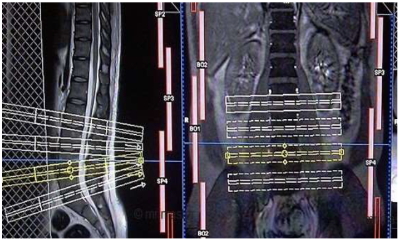 <p>Why are the axial slices on these lumbar spine planning scans angled? </p>