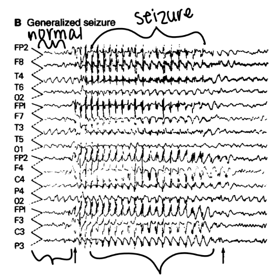 <p>EEG</p>