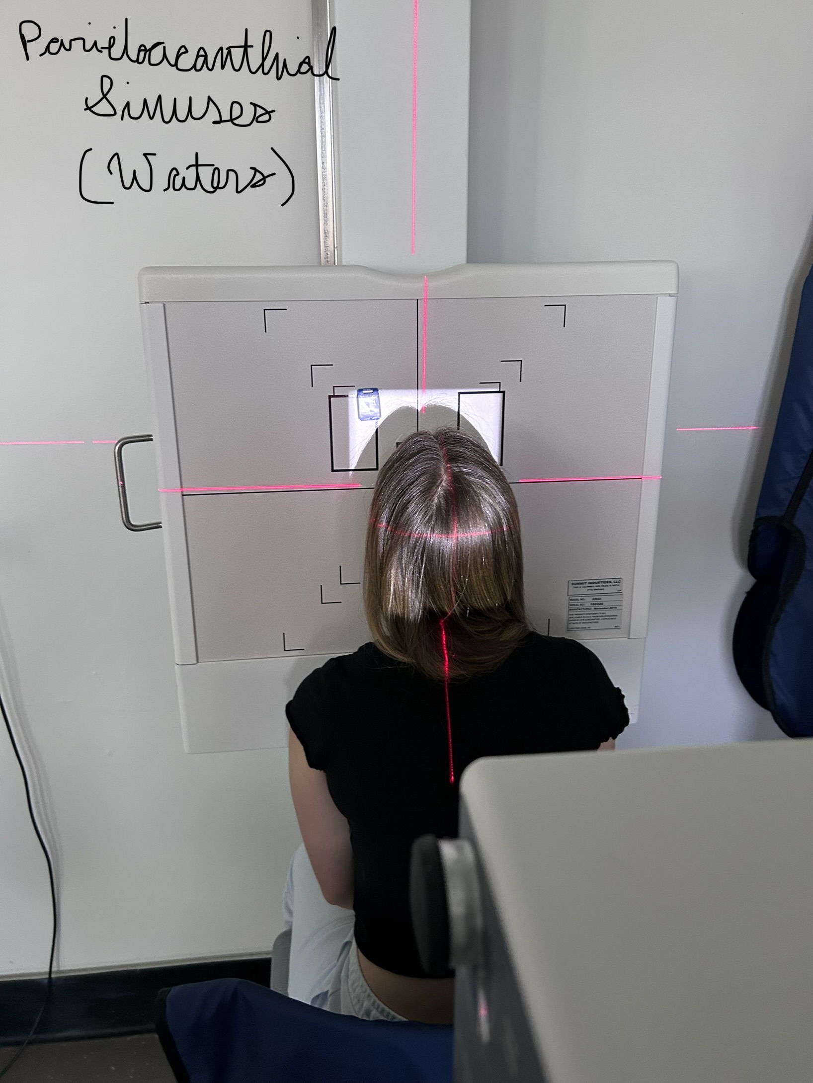 Parietoacanthial Sinuses (Waters)