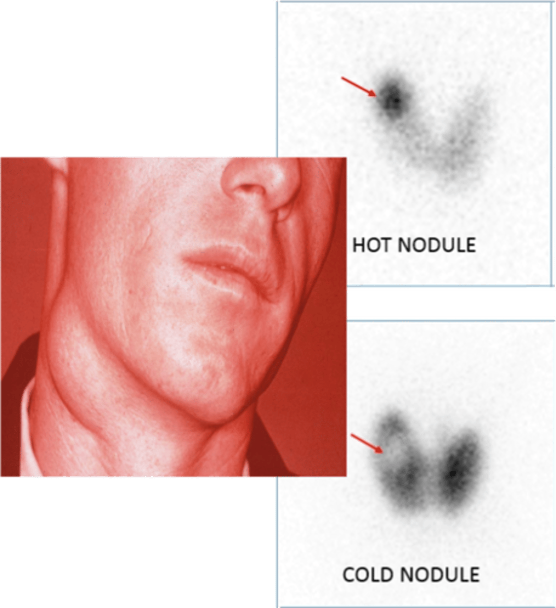 <p>Define Condition:</p><p>-Sx/PE: Solitary Thyroid Nodule</p><p>-Prog: MOST ARE BENIGN</p><p>-Dx:</p><p>&gt; Check TSH to determine if functional or non-functional</p><p>&gt; Fine Needle Aspiration</p><p>&gt; Functional</p><p>&gt;&gt; Low TSH</p><p>&gt;&gt; Radioactive iodine uptake (RAIU) confirm it to be "hot"</p><p>&gt; Non-Functional</p><p>&gt;&gt; Normal or High TSH</p><p>&gt;&gt; RAIU show low uptake/cold (10% cold = MALIGNANT)</p>