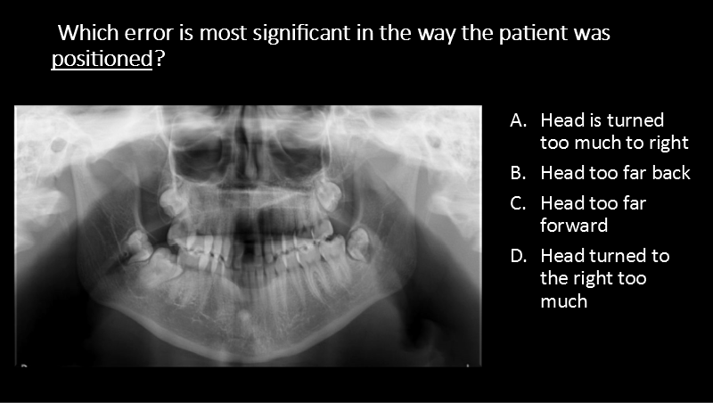<p> Which error is most significant in the way the patient was positioned?</p><p>A. Head is turned too much to right</p><p>B. Head too far back</p><p>C. Head too far forward</p><p>D. Head turned to the right too much</p>