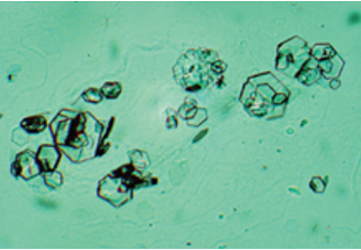 <p>-Colorless hexagons</p><p>-Seen in patients with Cystinuria</p>
