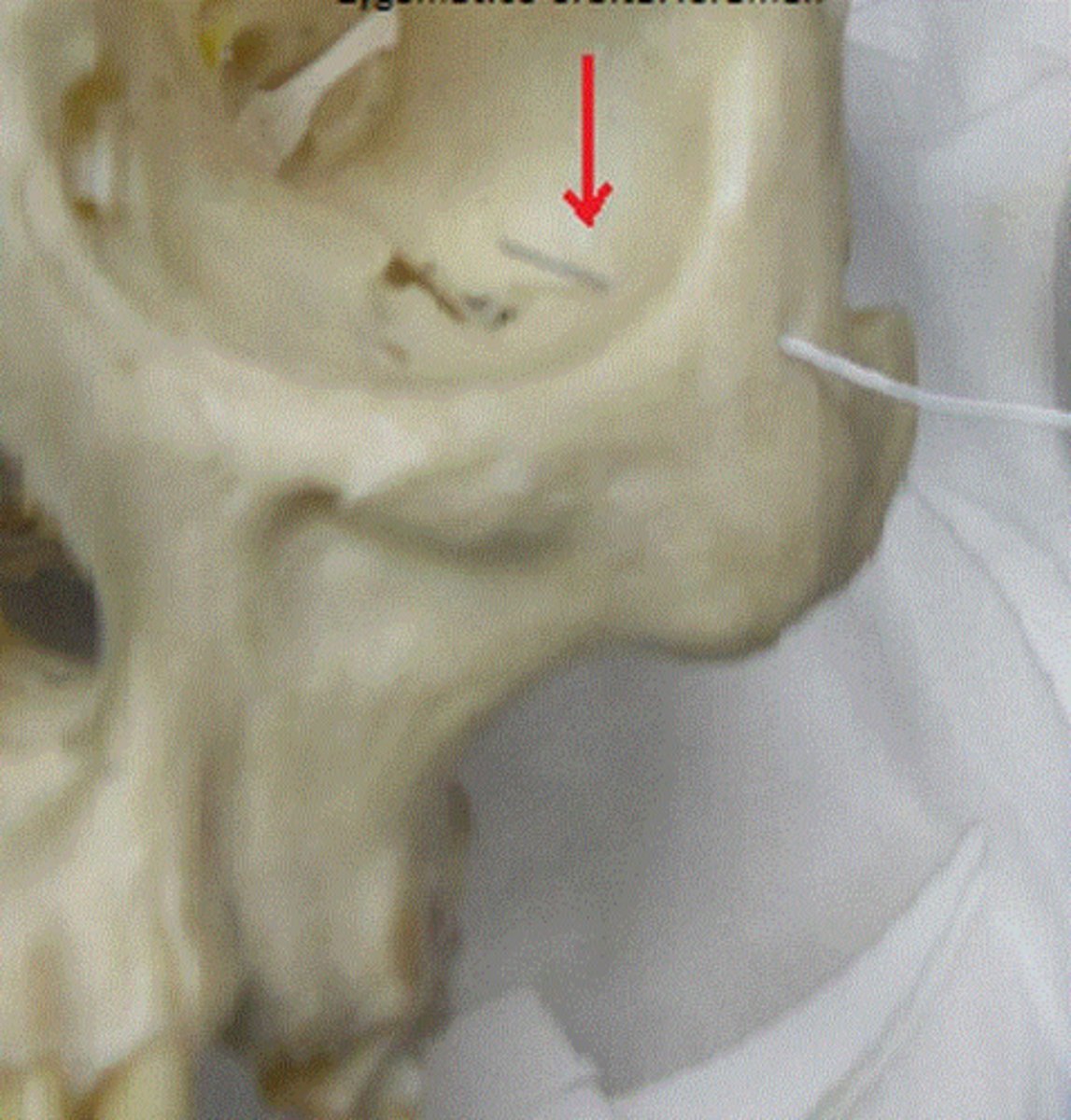 <p>What feature is this on zygomatic?</p>