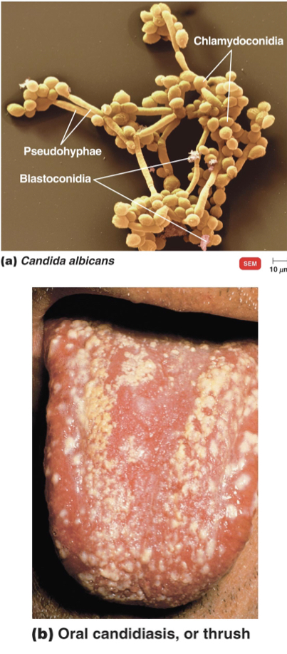 * Caused by Candida albicans (yeast) 
* Often results from suppression of competing bacteria by antibiotics 
* Occurs in skin and mucous membranes of urogenital tract (vaginitis) and mouth (thrush) 
* Treated topically with miconazole or nystatin 

\
