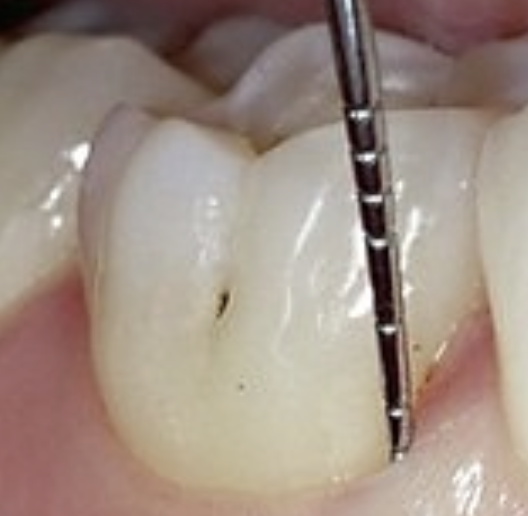 <p>Where are buccal pits found?</p>
